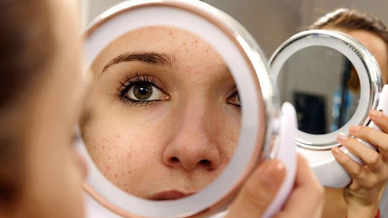 woman acne 3 | | Mengapa Sepertinya Jerawat Bertambah Banyak Saat Pandemik?