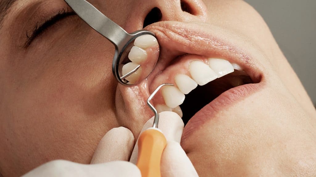 cara membersihkan karang gigi 9 | | Bagaimana Cara Membersihkan Karang Gigi yang Tepat
