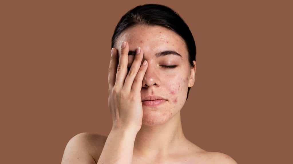 young woman with acne | | Rahasia dan Cara Mengecilkan Pori-Pori Wajah dari Dermatolog