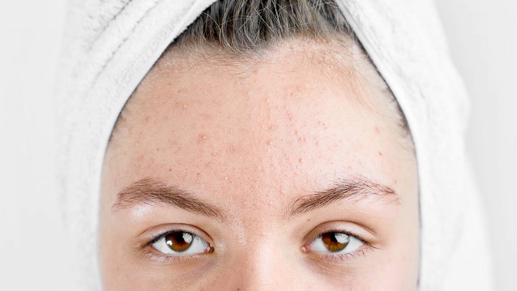 apa itu kulit bruntusan | | Adakah Skincare Routine Khusus Untuk Kulit Bruntusan? Ini Jawaban Dermatolog