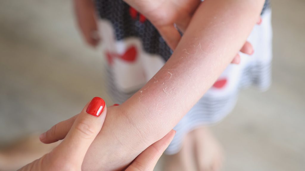 apa saja jenis ruam kulit yang dialami oleh anak | | Ruam Kulit Pada Anak, Kapan Harus Ke Dokter? Ini Penjelasan Ahli