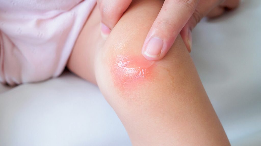 bagaimana cara mengatasi penyakit ruam kulit | | Ruam Kulit Pada Anak, Kapan Harus Ke Dokter? Ini Penjelasan Ahli