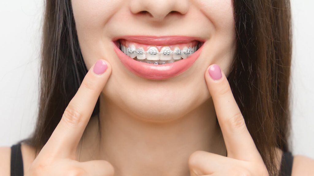 adakah risiko pemasangan kawat gigi | | Adakah Usia Ideal Untuk Memakai Kawat Gigi? Ini Penjelasan Dokter Spesialis