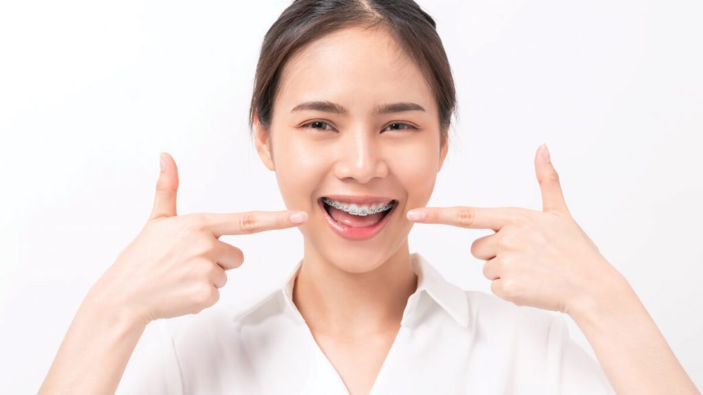 memasang kawat gigi | | Adakah Usia Ideal Untuk Memakai Kawat Gigi? Ini Penjelasan Dokter Spesialis