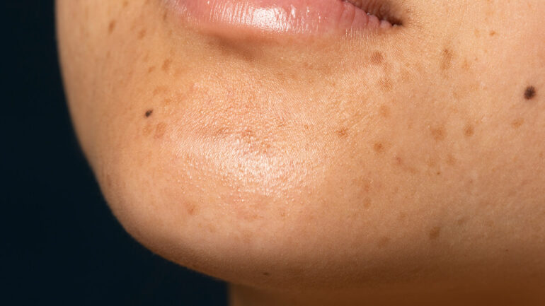 cara menghilangkan noda hitam di wajah | | Cara Ampuh Menghilangkan Noda-Noda Hitam di Wajah Menurut Dokter